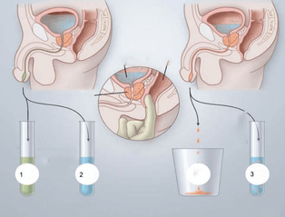 massage de la prostate