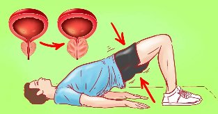 Exercice pour la prostatite