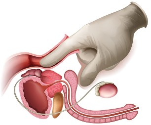 massage de la prostate