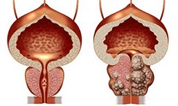 Saine et de la malbouffe de la prostate