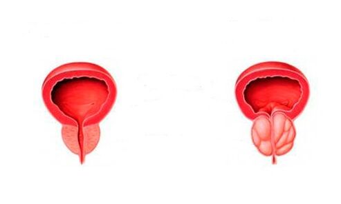 prostate saine et enflammée avec prostatite