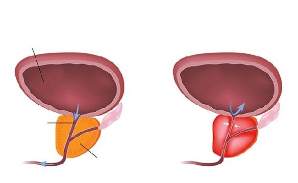prostate normale et enflammée